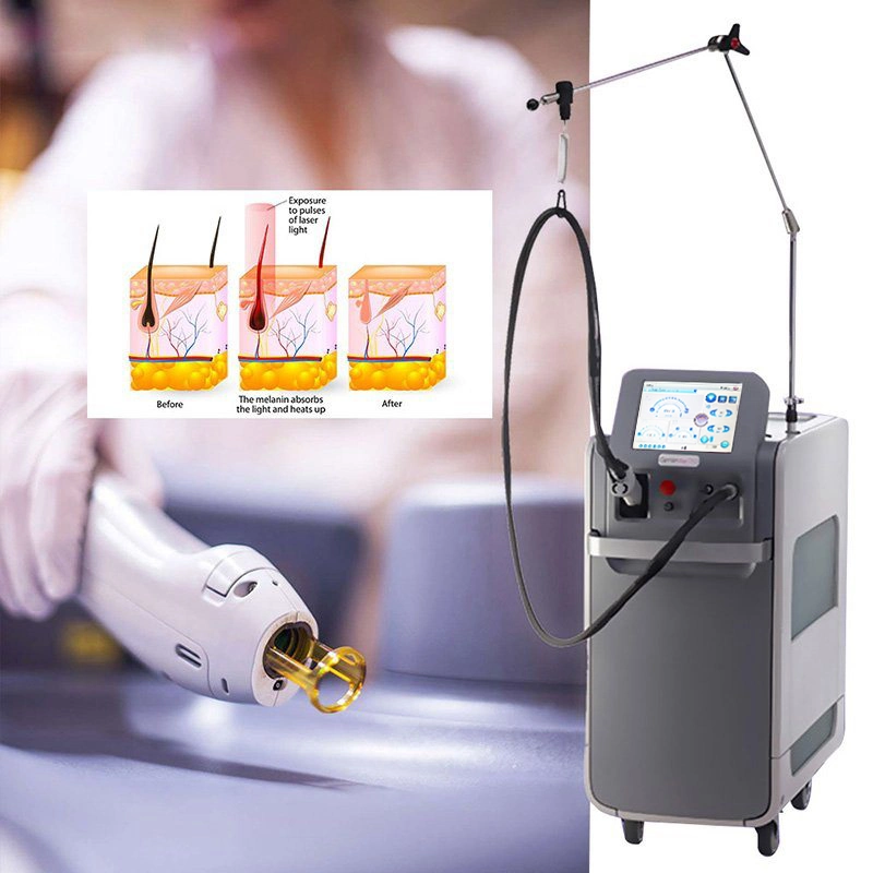 Long Pulsed ND YAG 1064nm Alexandrite 755nm Laser Gentle PRO Laser for Hair Removal